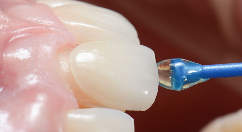 cementing dental veneers on a tooth surface