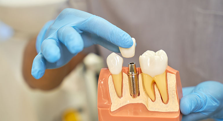 doctor putting crown on a dental implant