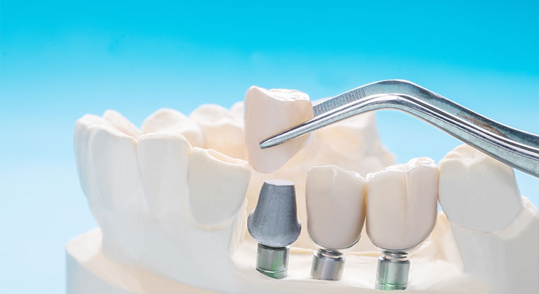 laboratory dental implants