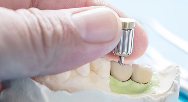 doctor tightening a dental implant's screw