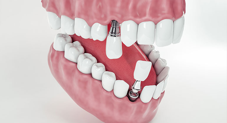 dental implants titanium screw