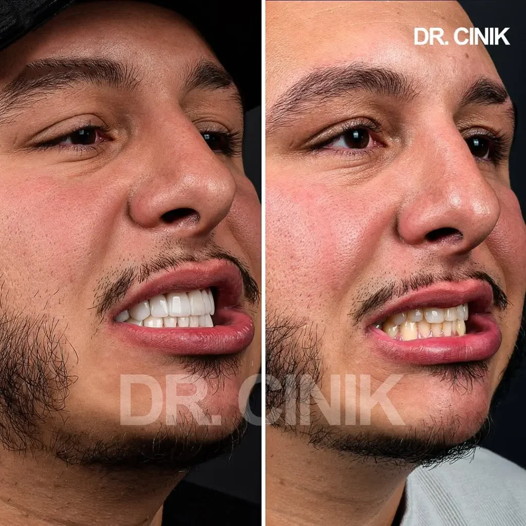 Smile makeover with emax veneers at dr cinik Hospital