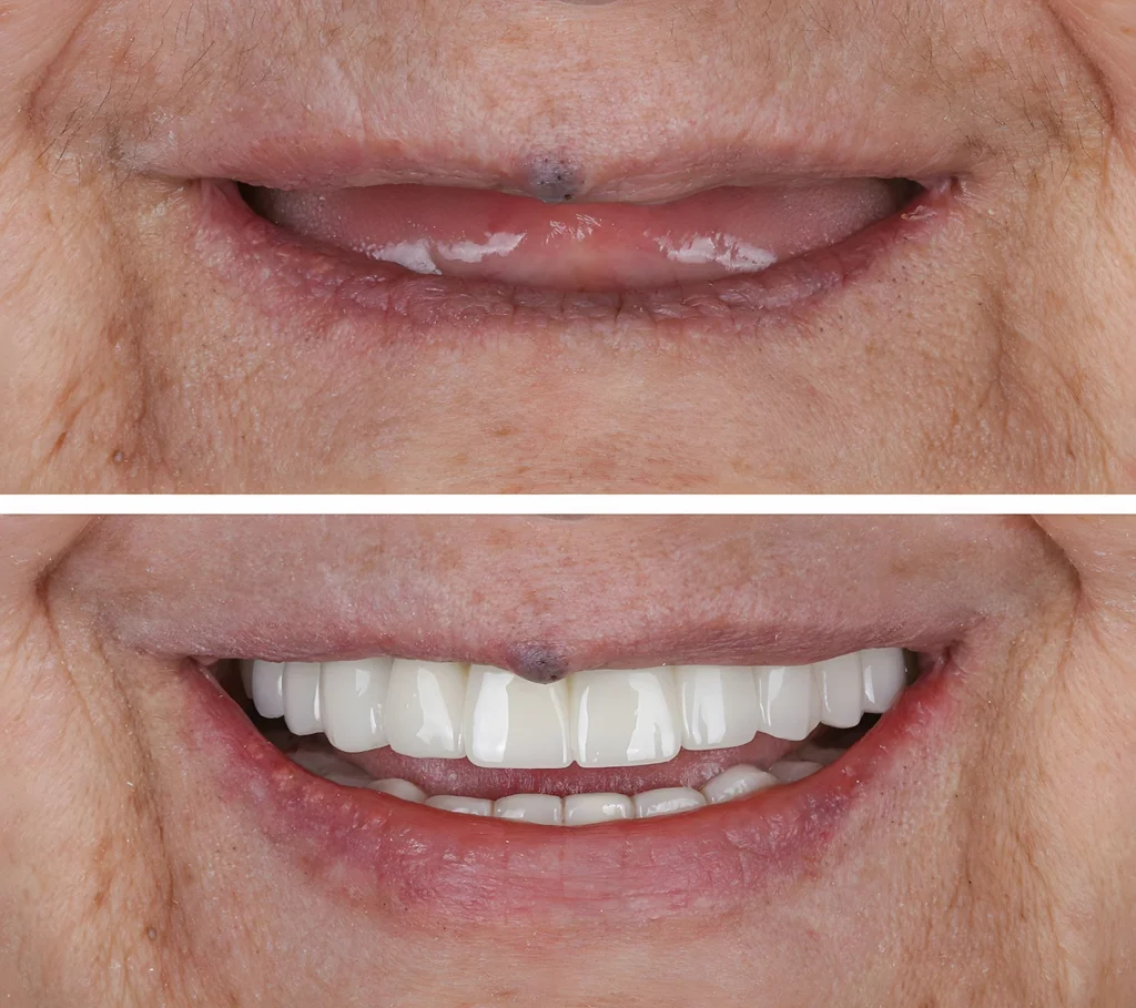Dental implants before after results