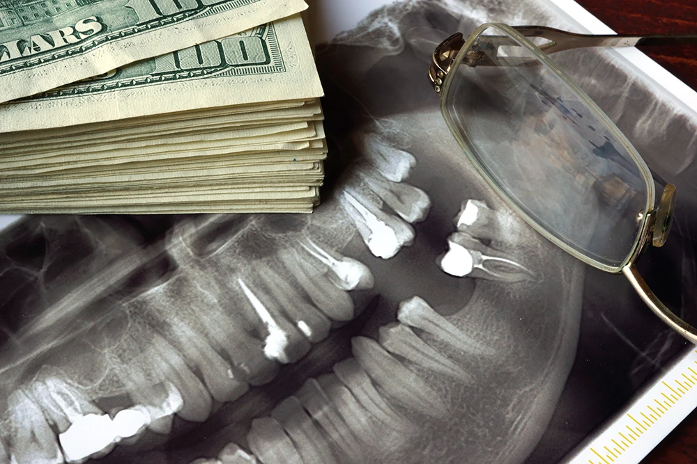 Cost difference between all-on-4 and all-on-6 dental implants