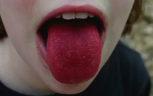strawberry tongue