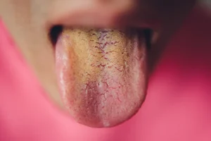 yellow tongue