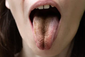 black tongue