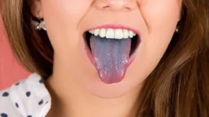 Blue tongue