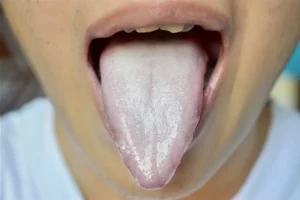 White tongue
