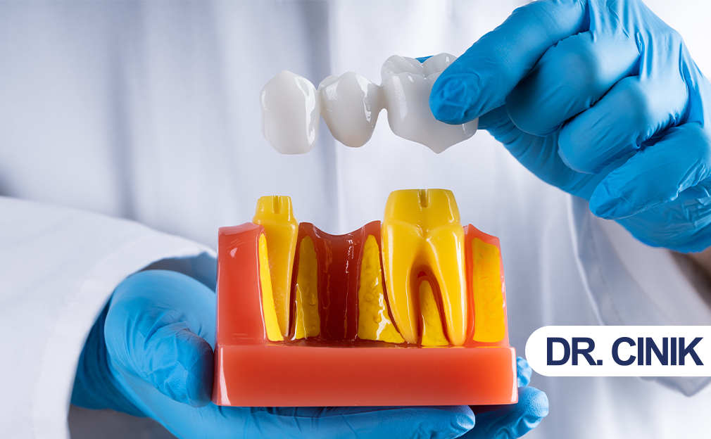 what is a dental bridge