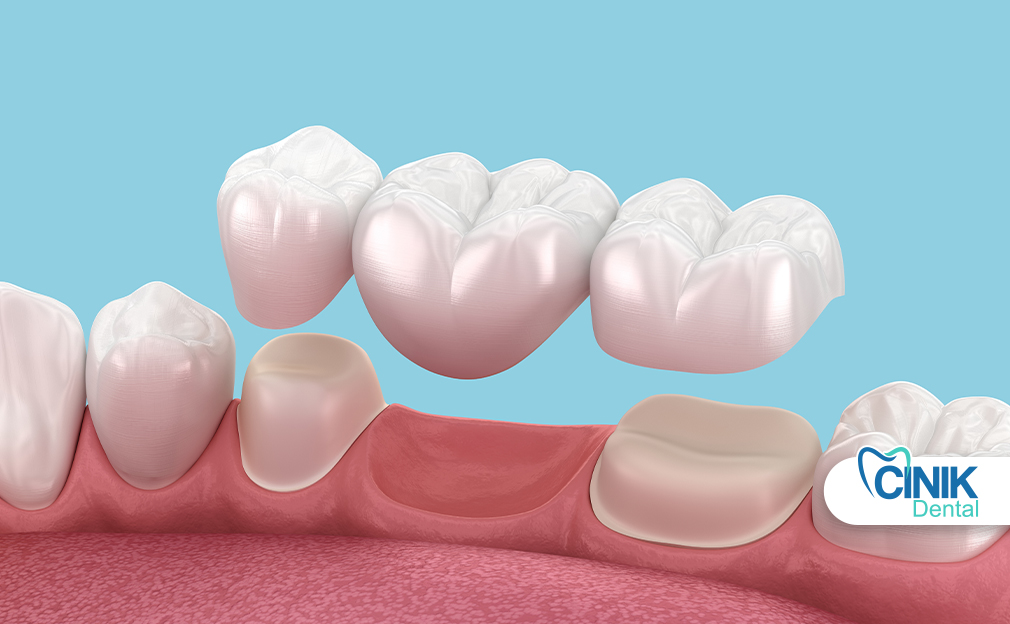 What is a dental bridge and its cost, durability, and appearance? What is a dental bridge and its cost, durability, and appearance?