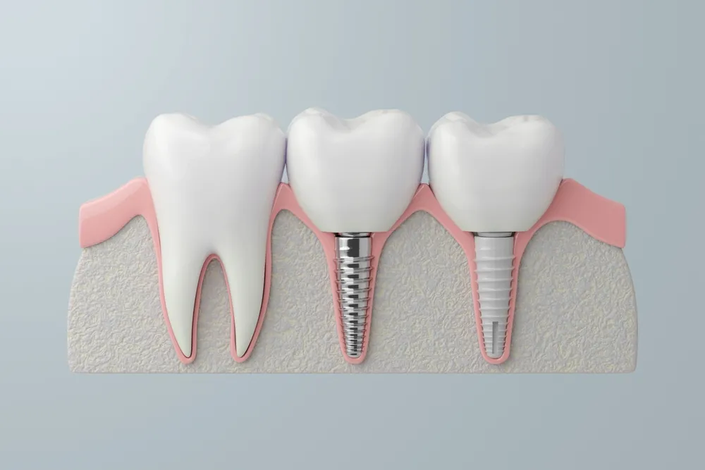 Why Do UK Patients Travel to Turkey for Zirconia Implants? Why Do UK Patients Travel to Turkey for Zirconia Implants?