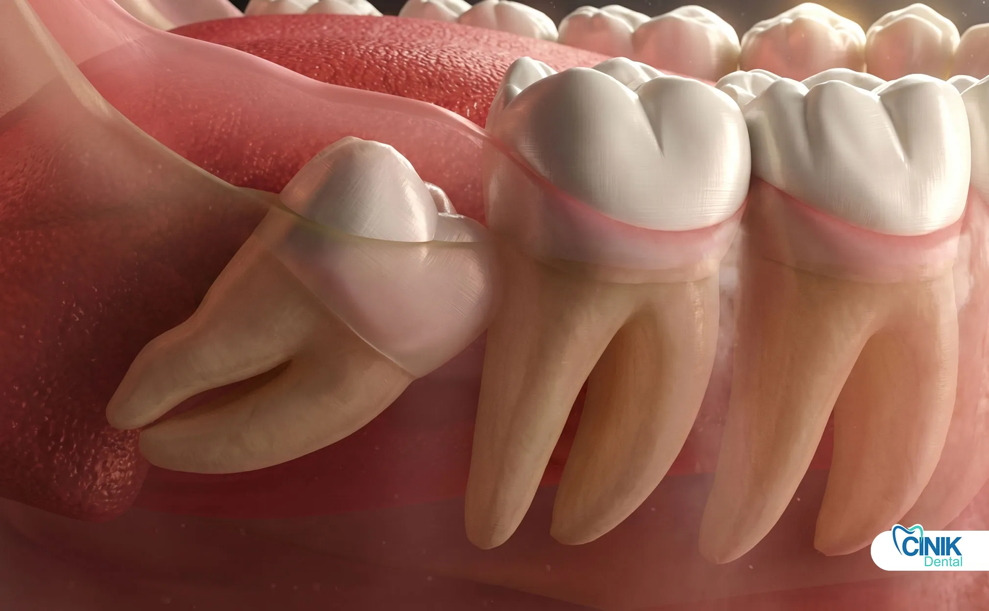 Comprehensive Guide to Wisdom Tooth Removal: Evidence-Based Insights for Optimal Outcomes Comprehensive Guide to Wisdom Tooth Removal: Evidence-Based Insights for Optimal Outcomes