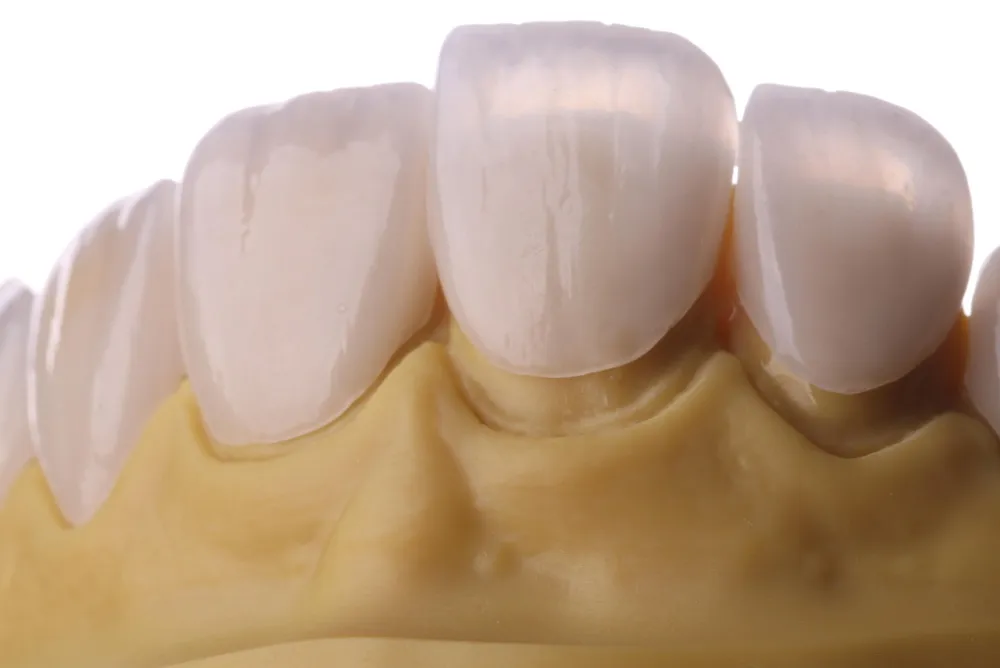 E.max Veneers vs Lumineers: What's the Difference? E.max Veneers vs Lumineers: What's the Difference?