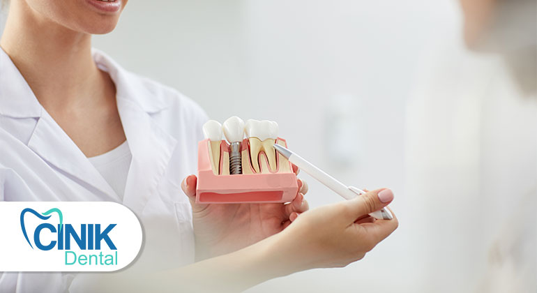 Почему зубные имплантаты являются золотым стандартом в замене зубов? Почему зубные имплантаты являются золотым стандартом в замене зубов?