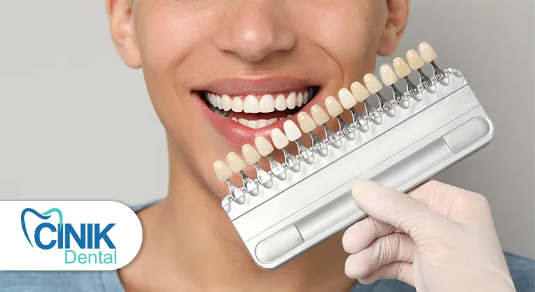 Full-Mouth Veneers’ Cost: What No One Tells You (But You Need to Know) Full-Mouth Veneers’ Cost: What No One Tells You (But You Need to Know)