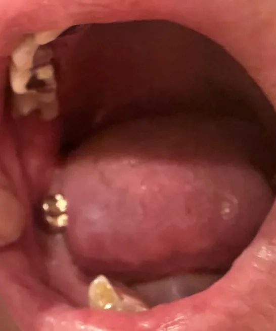 Can I Have Dental Implants at 83 With Controlled Atrial Fibrillation?