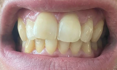 Can I Have 24 Zirconia Crowns for a Full Smile Makeover?
