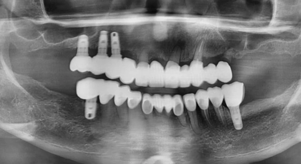 Can I Have Full-Mouth Implant Treatment With Controlled Diabetes and High Blood Pressure?