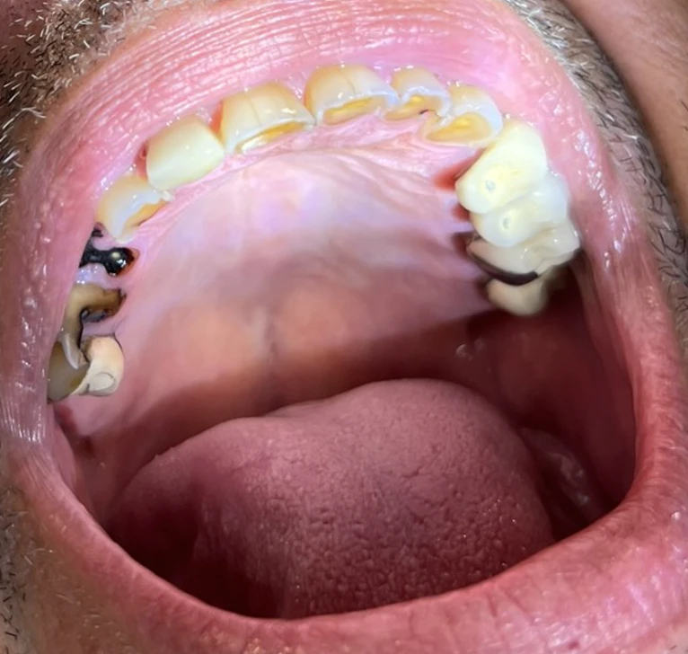 Can I Have a Full Smile Makeover With Implants and Zirconia Crowns?