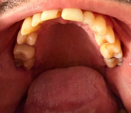 Can I Choose Between Veneers With Implants or a Full Zirconia Smile Makeover?