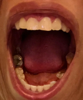 Can I Have Implants and Zirconia Crowns With Gummy Smile Treatment?