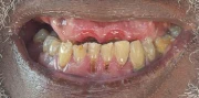Posso ter dentes fixos com implantes e coroas de zircônia?