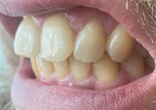 Can I Have 24 Zirconia Crowns for a Full Smile Makeover?