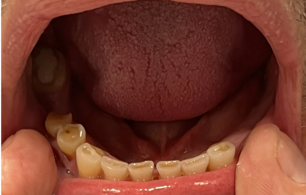Can I Have a Full Smile Makeover With Implants and Zirconia Crowns?