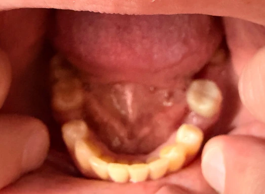 Can I Choose Between Veneers With Implants or a Full Zirconia Smile Makeover?