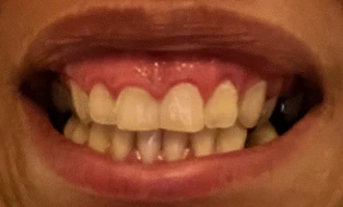 Can I Have Implants and Zirconia Crowns With Gummy Smile Treatment?