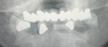 ¿Cuáles son mis opciones de implantes de boca completa con pérdida ósea severa en el maxilar superior?
