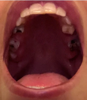 Can I Have Implants and Zirconia Crowns With Gummy Smile Treatment?