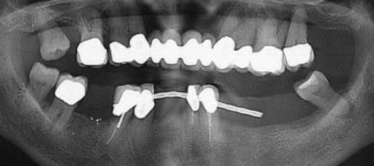 ¿Cuáles son mis opciones de implantes de boca completa con pérdida ósea severa en el maxilar superior?