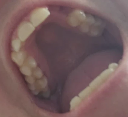Can I Replace My Missing Teeth With Implants and Zirconia Crowns?