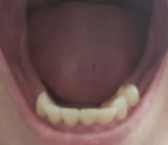 Can I Replace My Missing Teeth With Implants and Zirconia Crowns?