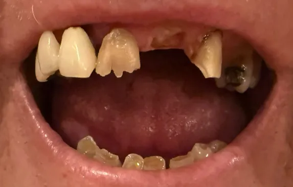 Can I Have Dental Implants at 83 With Controlled Atrial Fibrillation?