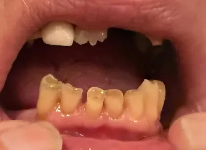 Can I Have Dental Implants at 83 With Controlled Atrial Fibrillation?