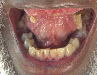 Posso ter dentes fixos com implantes e coroas de zircônia?