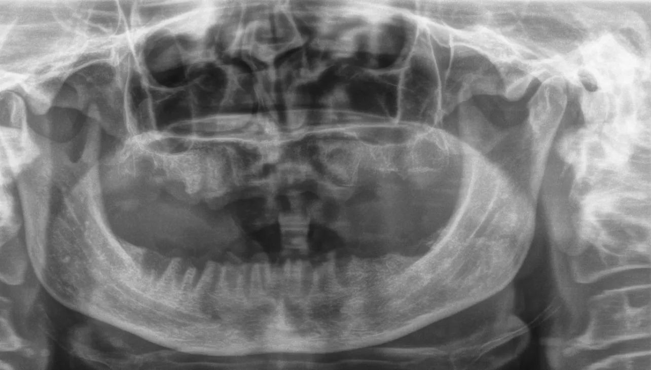 When Can I Have Dental Implants After Chemotherapy and Full-Mouth Extractions?