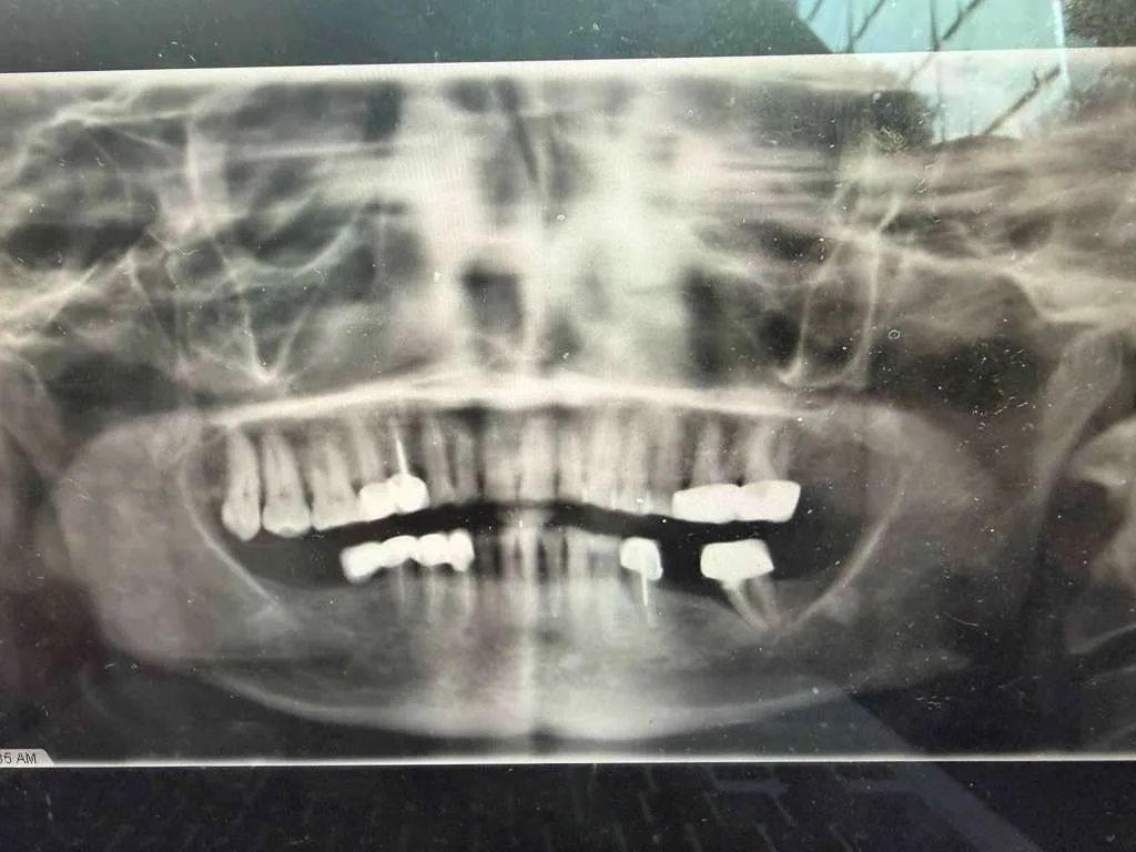 As a Diabetic Patient, Am I a Suitable Candidate for Implant and Comprehensive Dental Treatment?