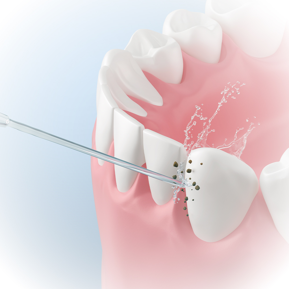 What is the Dental SPA Treatment Process?