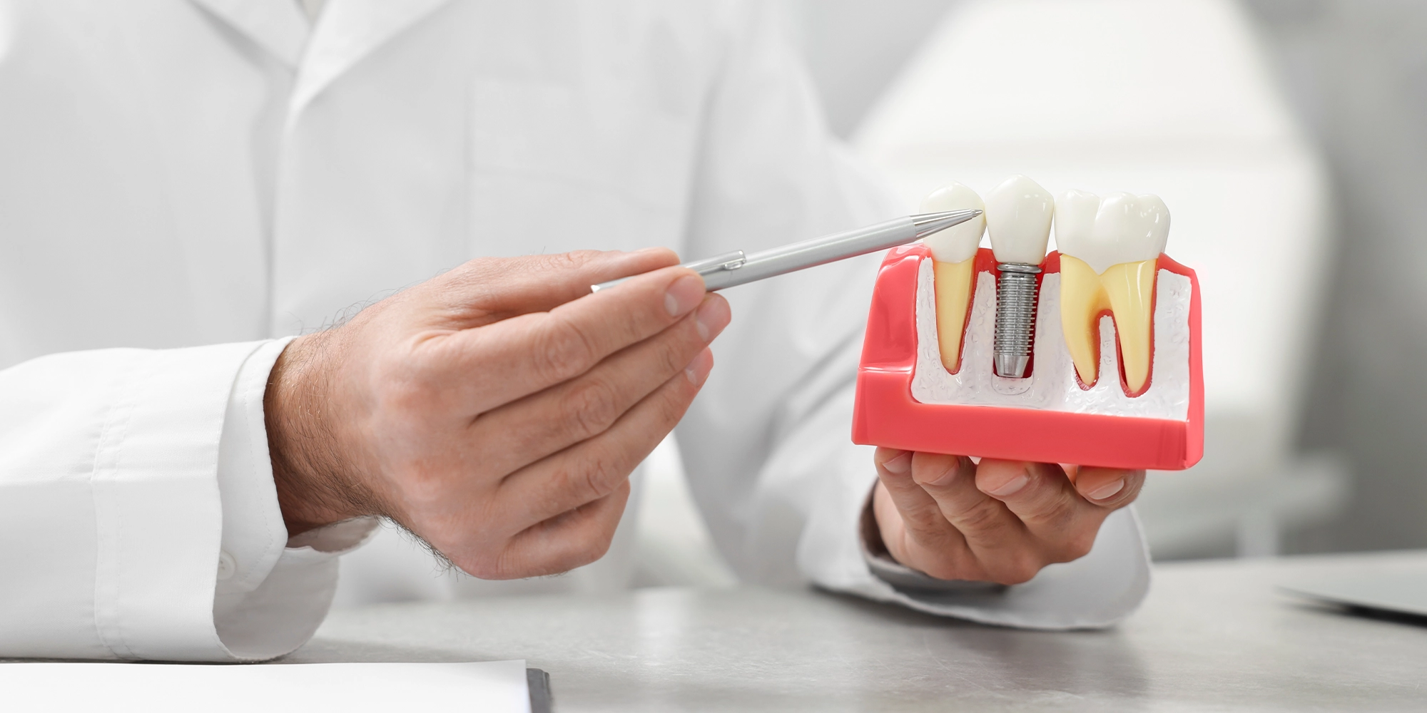 En iyi diş implantlarını belirleyen başlıca faktörler şunlardır: