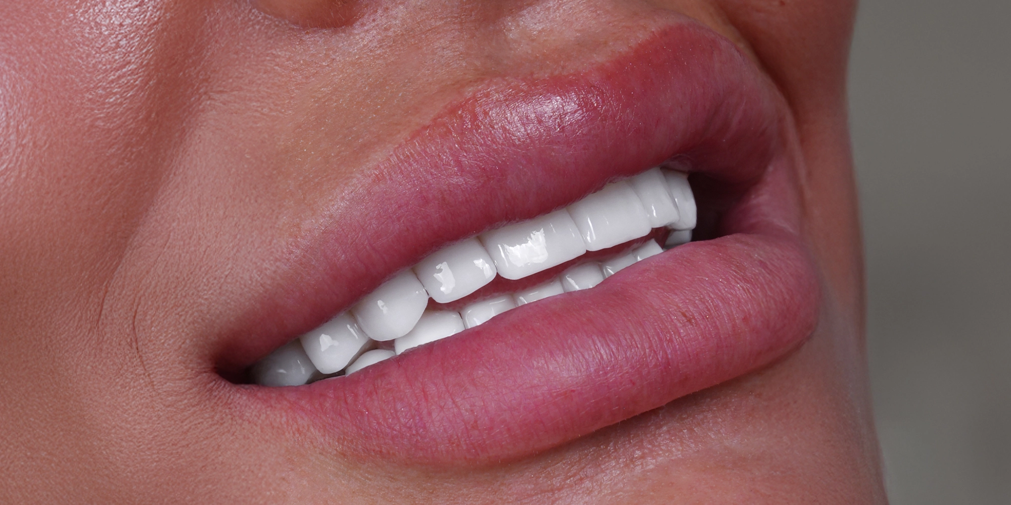 Dünya çapındaki bazı en iyi diş implantı markaları şunlardır: